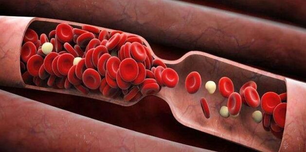 Prevention of blood clots