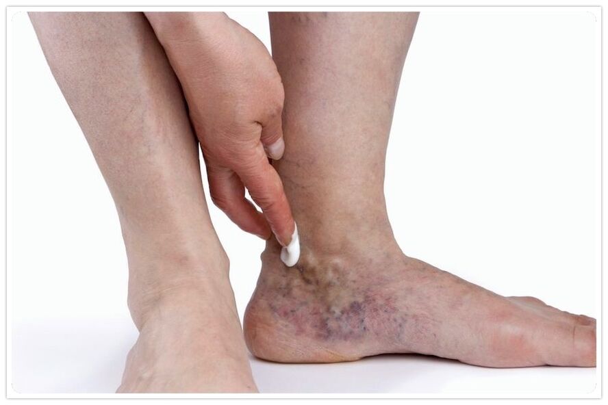 The advantages of the procedure for the veins