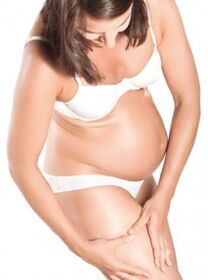 Varicose veins during pregnancy