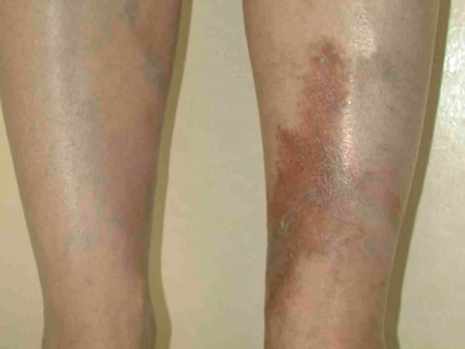 Stadiums of varicose veins