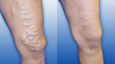 Signs and symptoms of varicose veins on the legs