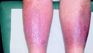 Third stage of varicose veins on the legs