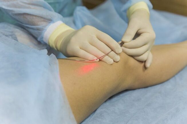 Laser treatment of varicose veins