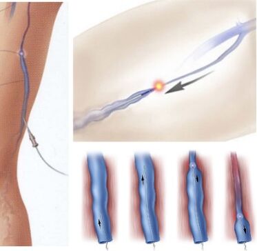 Method of treating varicose veins - endovenous laser coagulation