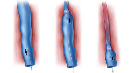 Radiofrequency ablation is a method of treating varicose veins