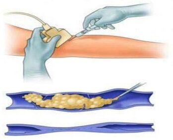 Sclerotherapy is a method of treating varicose veins