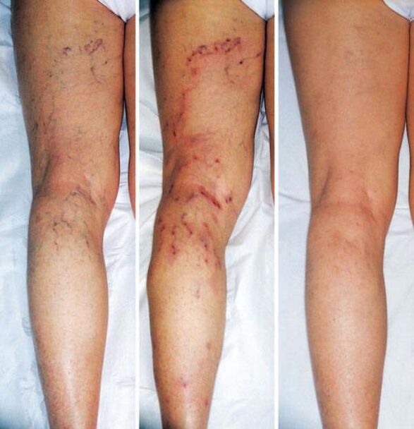 Stages of varicose veins of the lower extremities