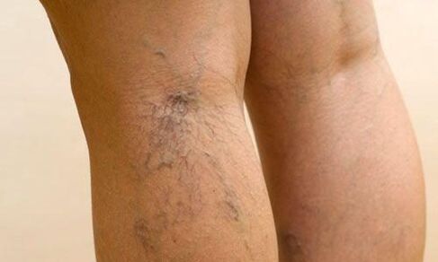 Varicose veins on the legs