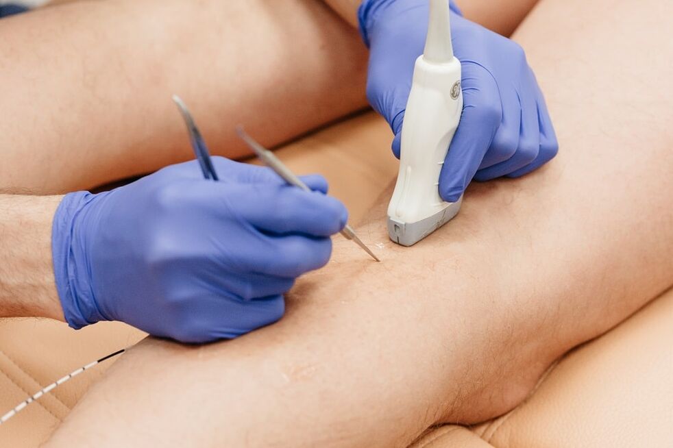 Removal of varicose veins under ultrasound control