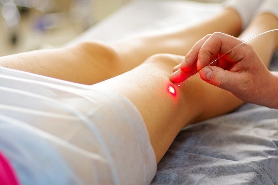 Laser treatment of varicose veins