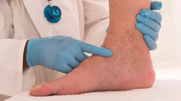 Doctor examines legs with varicose veins
