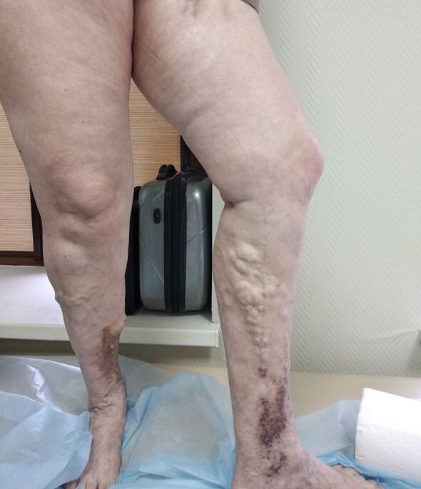 Legs with varicose veins
