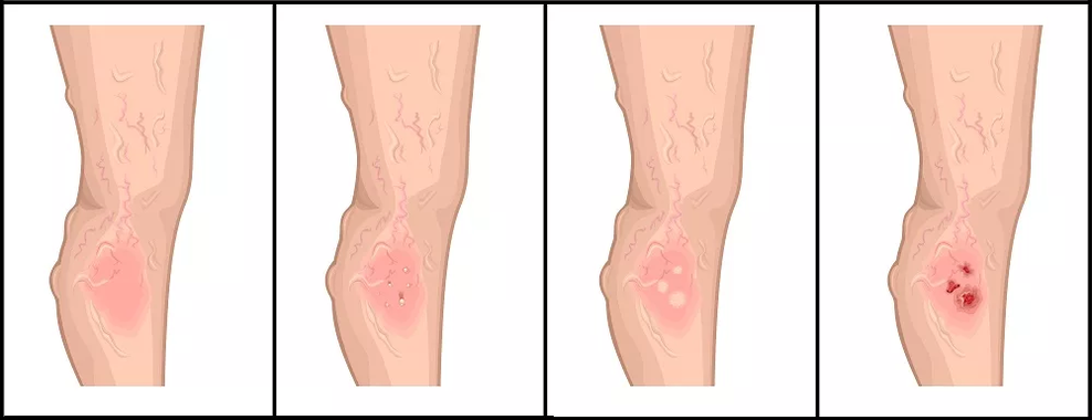 Stages of development of trophic ulcers in venous pathology