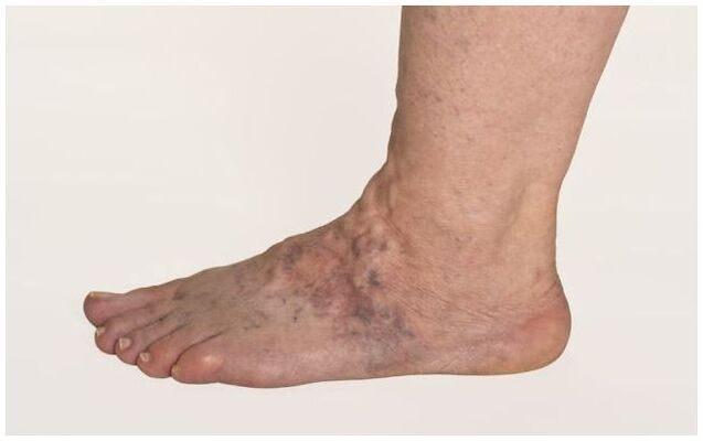 Varicose veins on a man's leg complicated by trophic ulcers