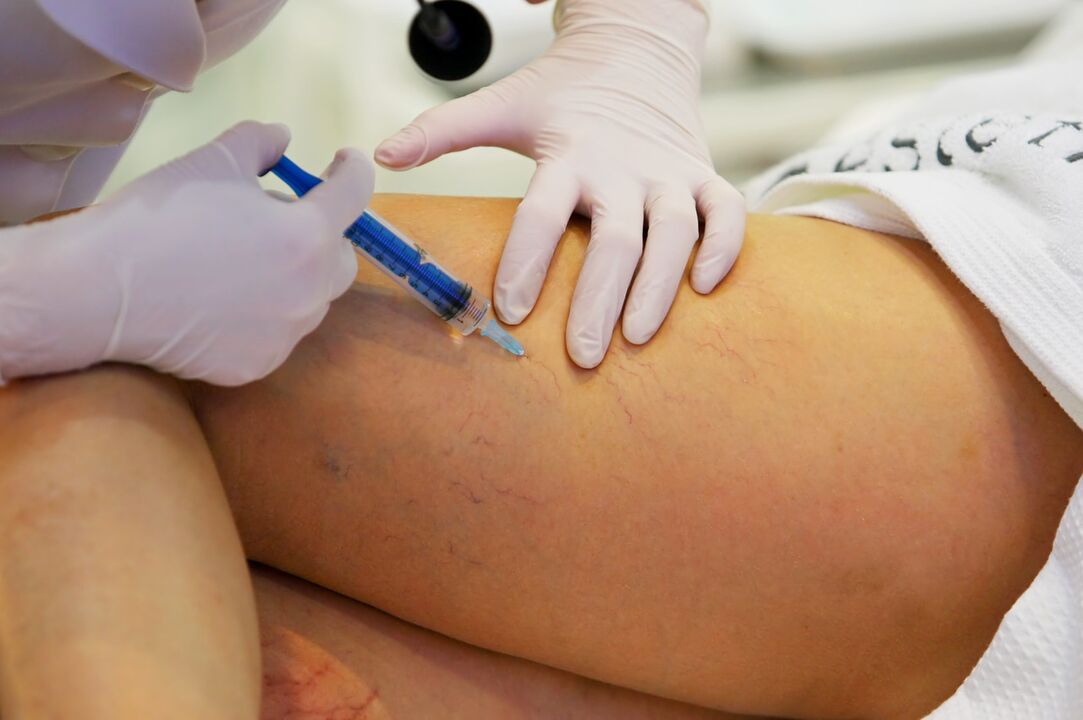 Injection to treat varicose veins