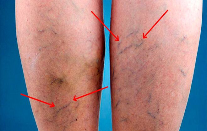 Protruding veins in the legs with varicose veins