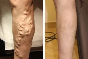 The result of the operation to eliminate varicose veins of the legs