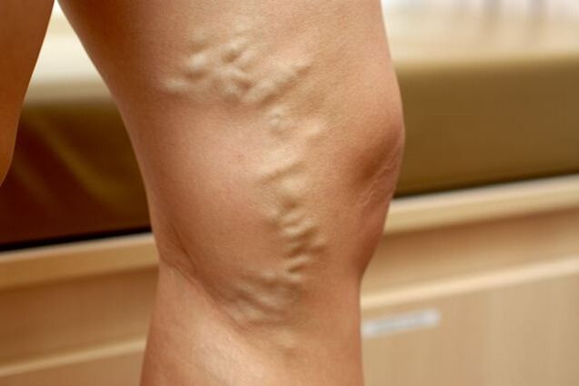 Protruding deformed vein on leg with stage 3 varicose veins