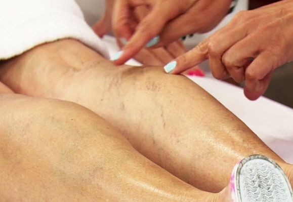 Examination of the legs with varicose veins in women