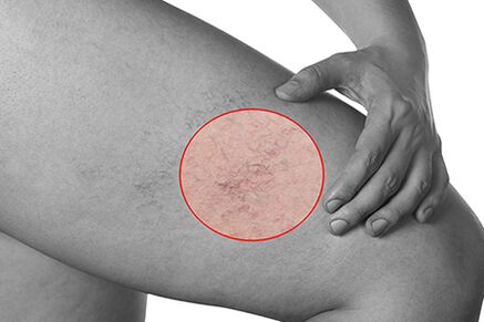 Telangiectasias in varicose veins of the lower extremities