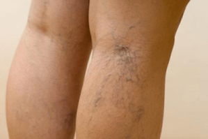 Photo of varicose veins on the legs