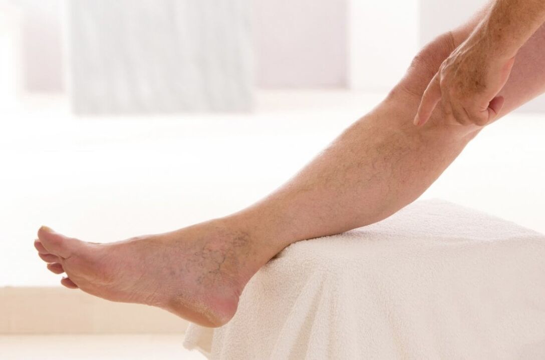 Symptoms of varicose veins in the leg