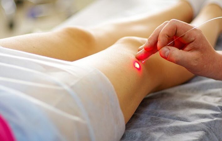 Laser method for treating varicose veins